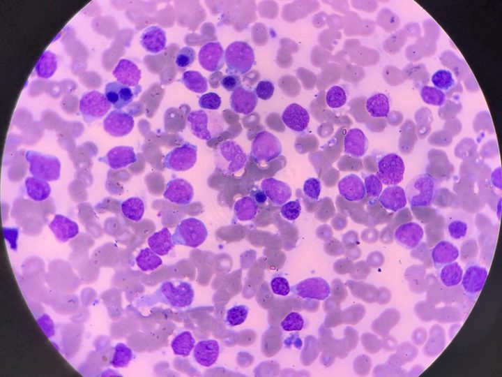 Bone marrow smear, total infiltration by blast cells (69% blasts)
