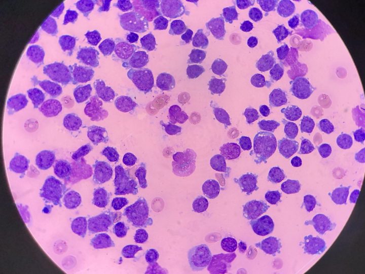 Cytological preparation of pericardial effusion, predominance of lymphoblasts