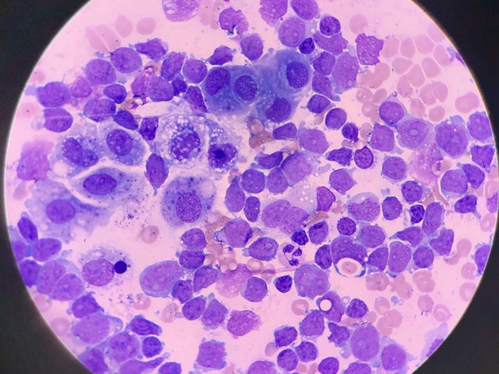 Smear of pleural effusion sediment with massive accumulation of blast cells