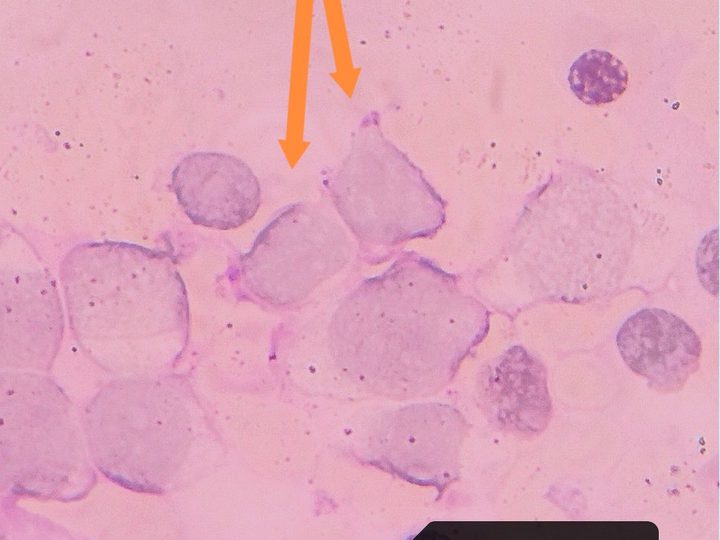 Cytochemical study, positive granular PAS reaction in blasts
