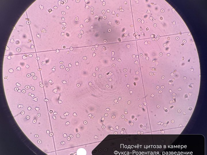 Fuchs-Rosenthal counting chamber, counting cytosis of effusion fluid (68,000 cells/µL)