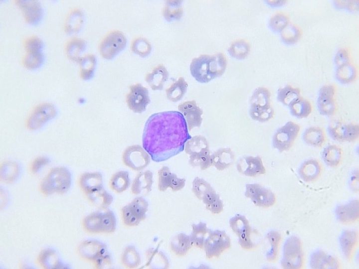 Мазок крови: одиночный типичный бласт со скудной цитоплазмой