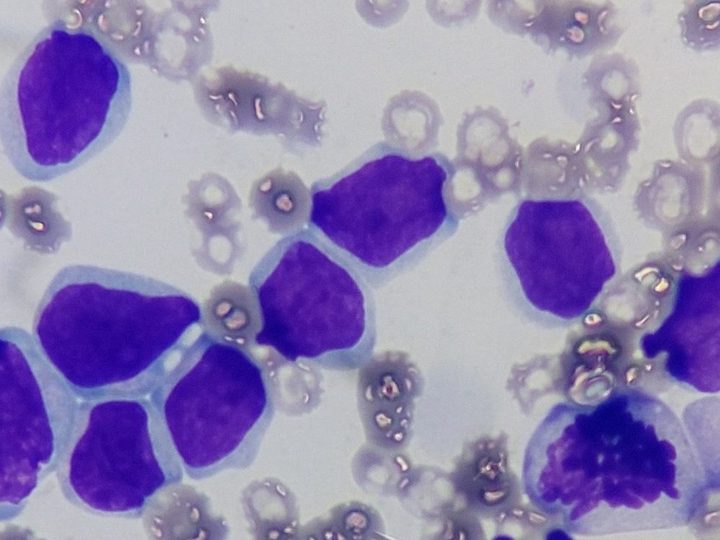 Dog blood smear: atypical lymphoid blasts and a dividing cell