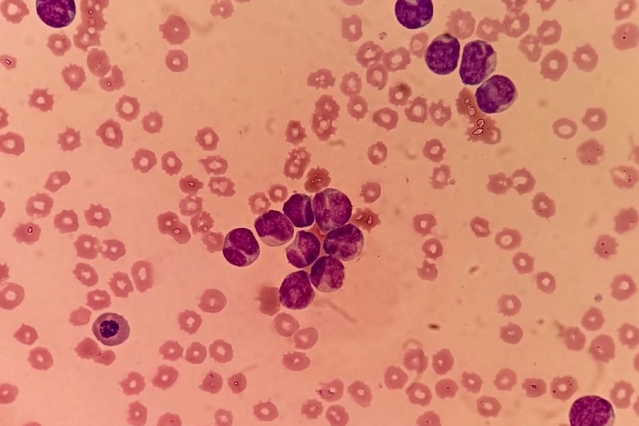 Acute Myeloid Leukemia: Blasts and Auer Rods in Blood