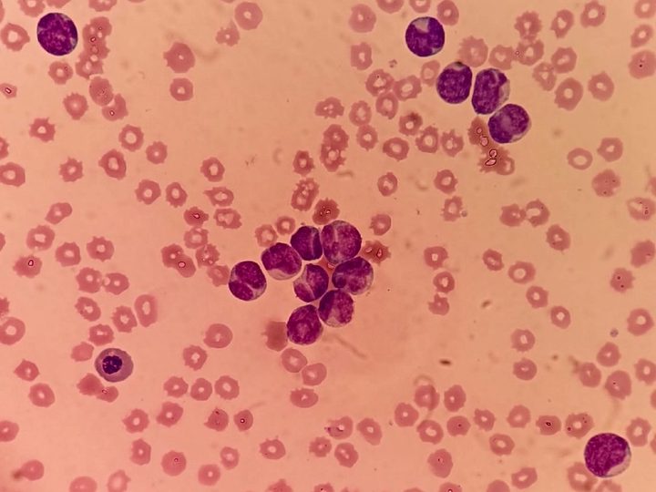 Blood smear: cluster of blast cells with characteristic nuclear deformation