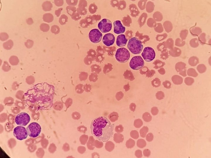 Blood smear: group of blasts, mature leukocyte, and a disrupted cell