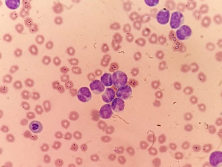 Blood smear: blasts with "angel wing" nuclear morphology