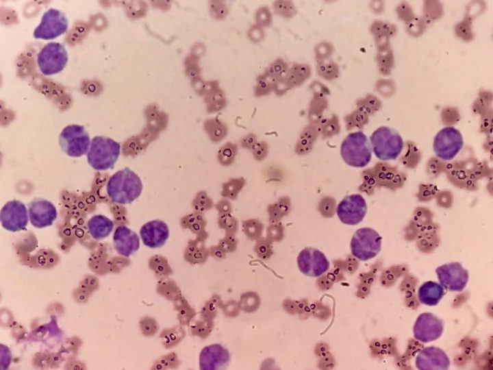 Blood smear: pronounced blastosis and hyperleukocytosis in the field of view