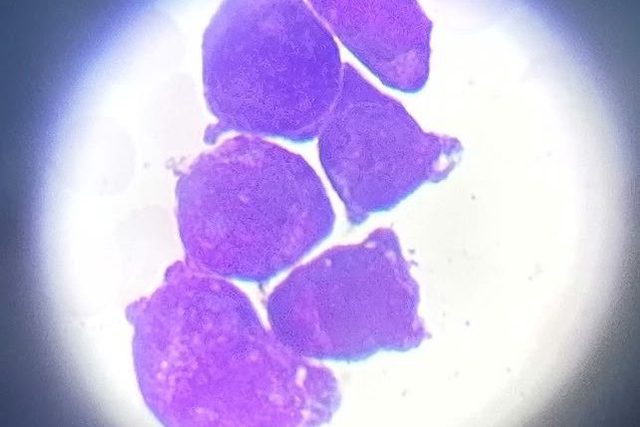 Acute Myeloid Leukemia: Blast Morphology and Auer Rods