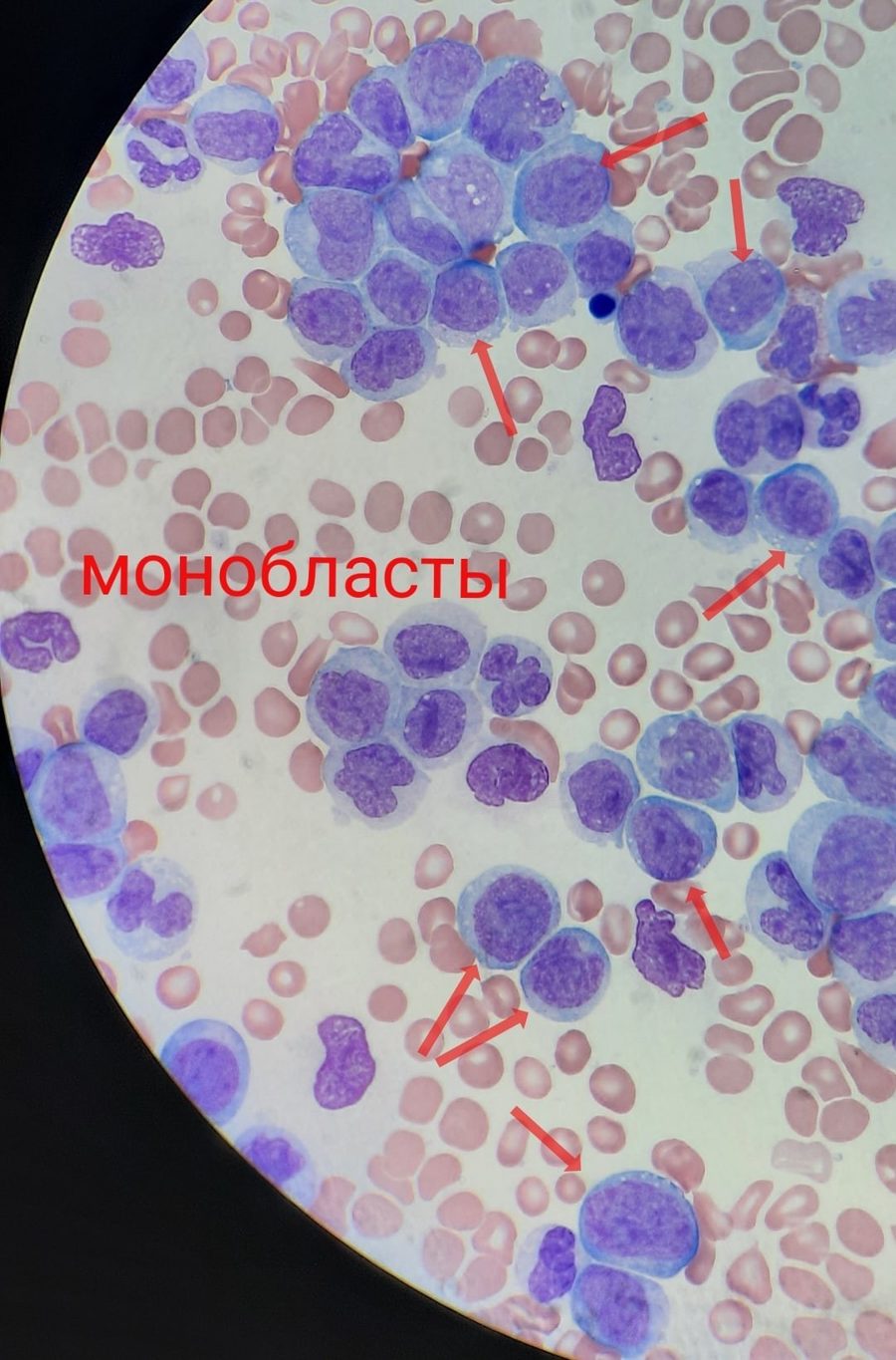 Острый моноцитарный лейкоз М5b: морфология клеток и ИФТ