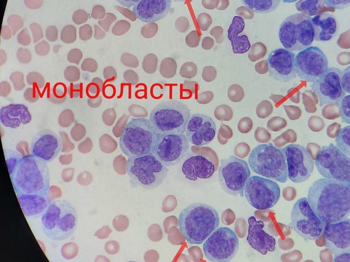 Мазок крови: скопление монобластов с базофильной цитоплазмой и ядрышками