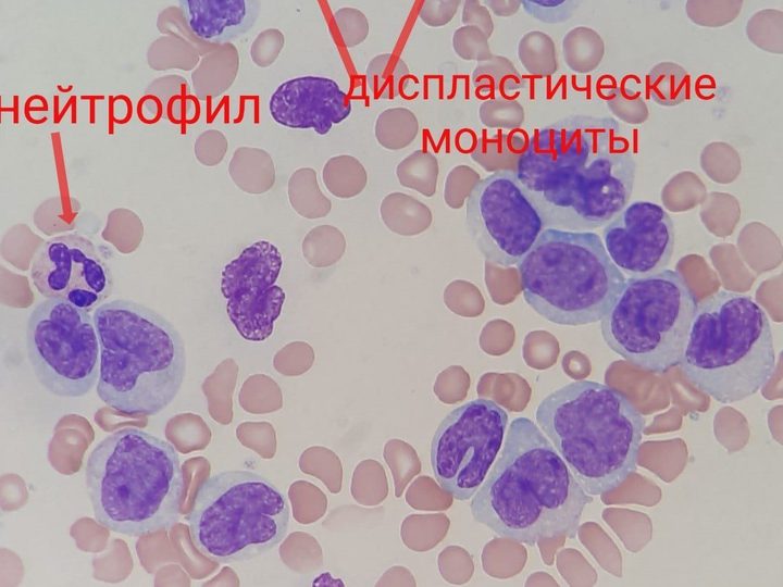 Мазок крови: диспластические моноциты с атипичными ядрами и нейтрофил