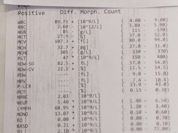 Распечатка анализатора: лейкоцитоз 89,73×10⁹/л, анемия и тромбоцитопения 47×10⁹/л