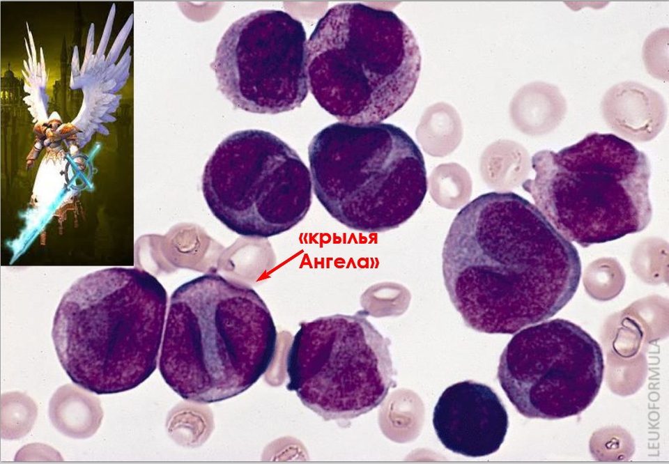 Bone marrow smear: atypical promyelocytes with angel wing-shaped nuclei in APL
