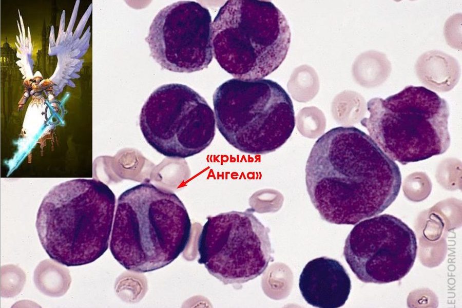 Acute Promyelocytic Leukemia: Hypogranular Variant M3v