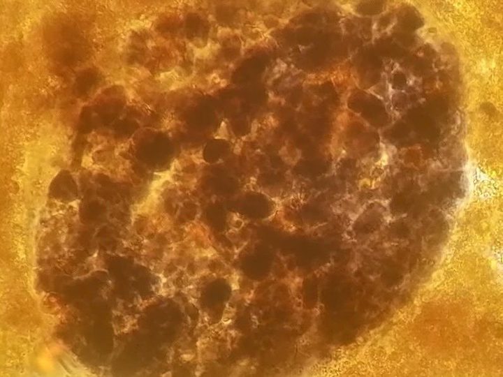 Stool microscopy, higher magnification: starch grains in fiber