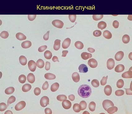 Blood smear: marked anisopoikilocytosis, ovalocytes, normoblast, and neutrophil