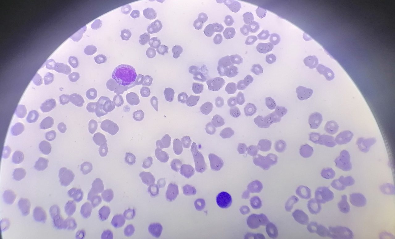 Primary Myelofibrosis: Blood and Bone Marrow Picture