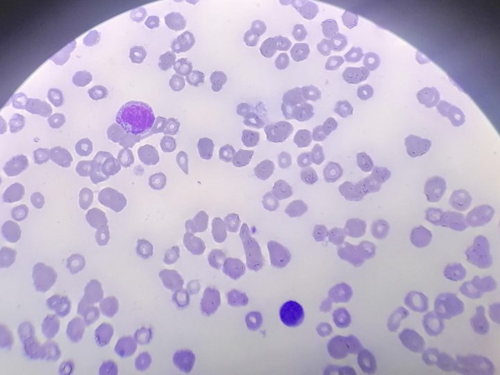 Blood smear: neutrophilic myelocyte and poikilocytosis with dacryocytes