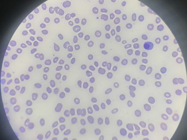 Blood smear: circulating normoblast and teardrop erythrocytes