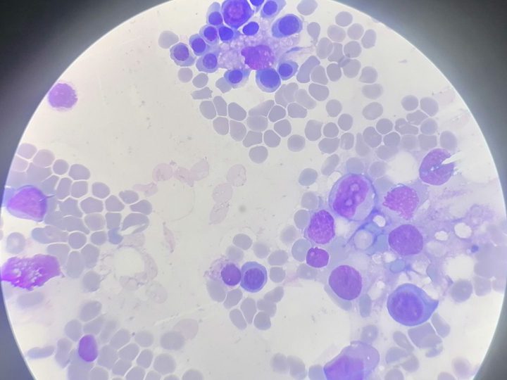 Bone marrow smear: erythroblastic island and myeloid cells