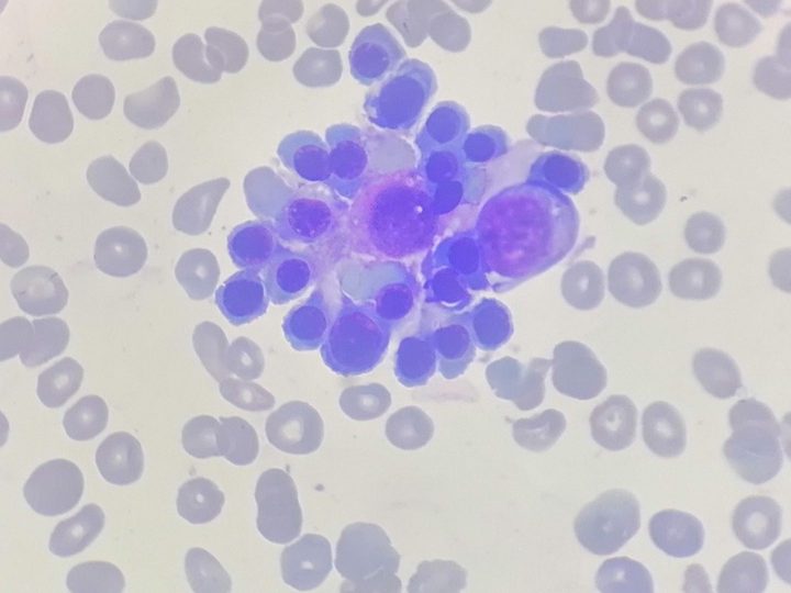 Bone marrow smear: erythroblastic island around a macrophage