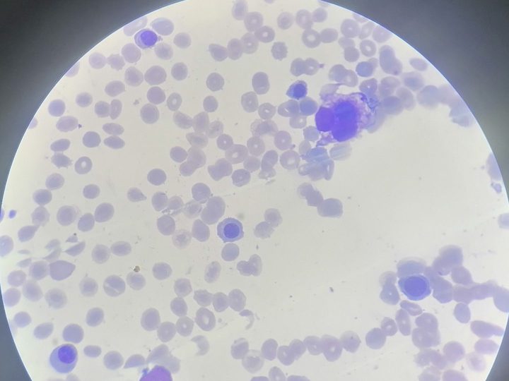 Bone marrow smear: erythrokaryocytes and granulocytic series cells
