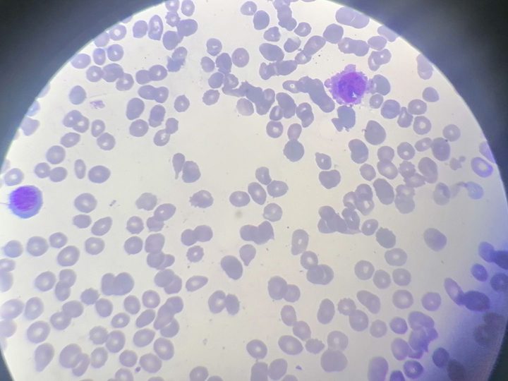 Bone marrow smear: immature cell, probable megakaryoblast