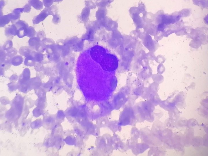 Bone marrow smear: atypical multinucleated megakaryocyte