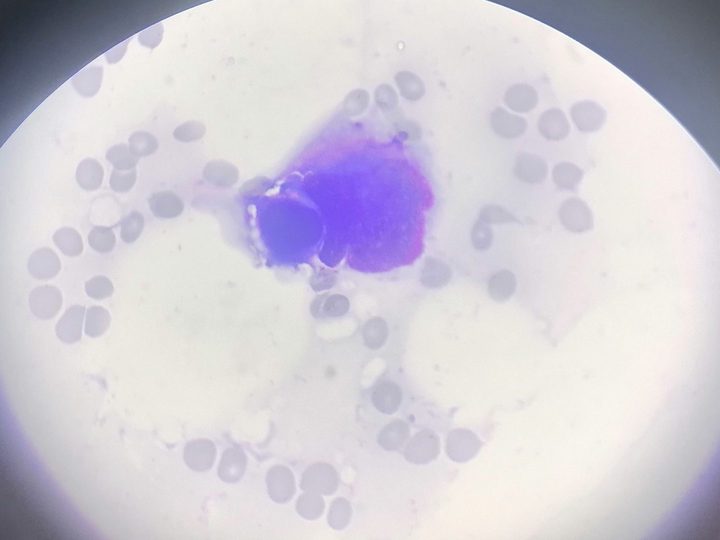 Bone marrow smear: dysplastic monolobated megakaryocyte