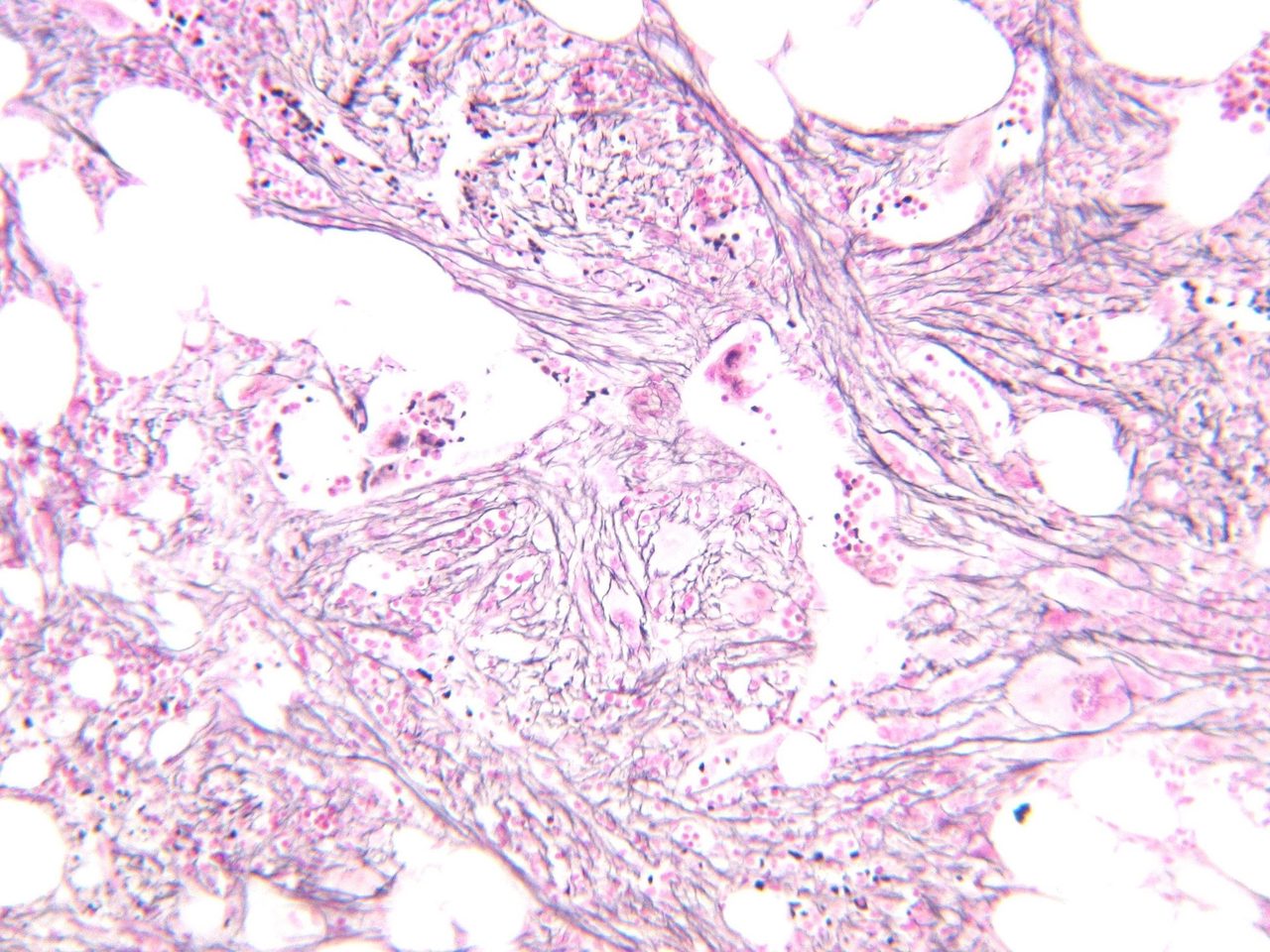 Primary Myelofibrosis MF-3 in Bone Marrow Biopsy