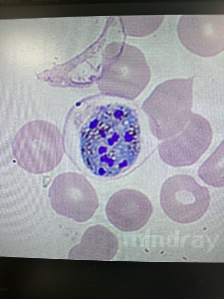 Plasmodium vivax в мазке крови: морфология стадий развития