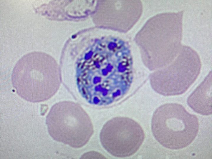 Мазок крови: зрелый шизонт Plasmodium vivax с дифференцированными мерозоитами