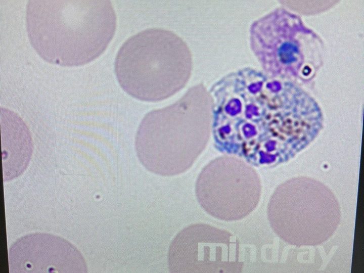 Мазок крови: шизонт и развивающийся трофозоит Plasmodium vivax в эритроцитах