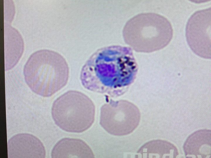 Мазок крови: амебовидный трофозоит Plasmodium vivax с включениями гемозоина