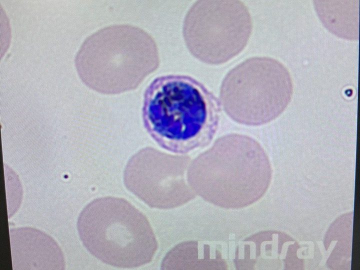 Мазок крови: зрелый макрогаметоцит Plasmodium vivax с малярийным пигментом