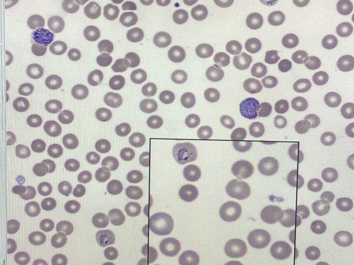 Экран цифровой станции: скопление эритроцитов с паразитами Plasmodium vivax