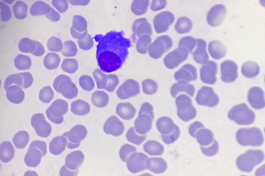 Plasma Cells in Blood Smear: Morphology and Flame Cells