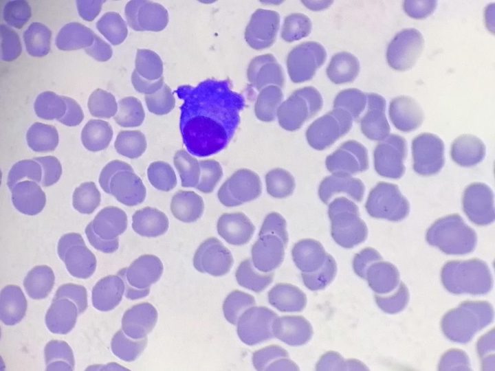 Blood smear: plasma cell with basophilic cytoplasm and eccentric nucleus