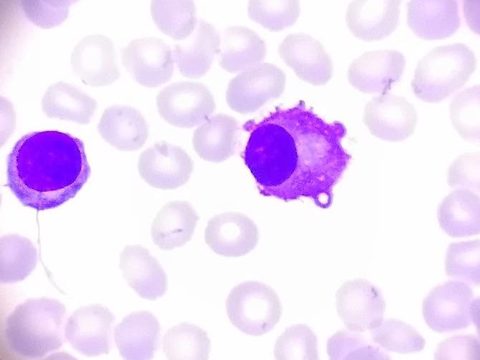 Blood smear: plasmacyte with irregular cytoplasmic contours and a mature lymphocyte nearby