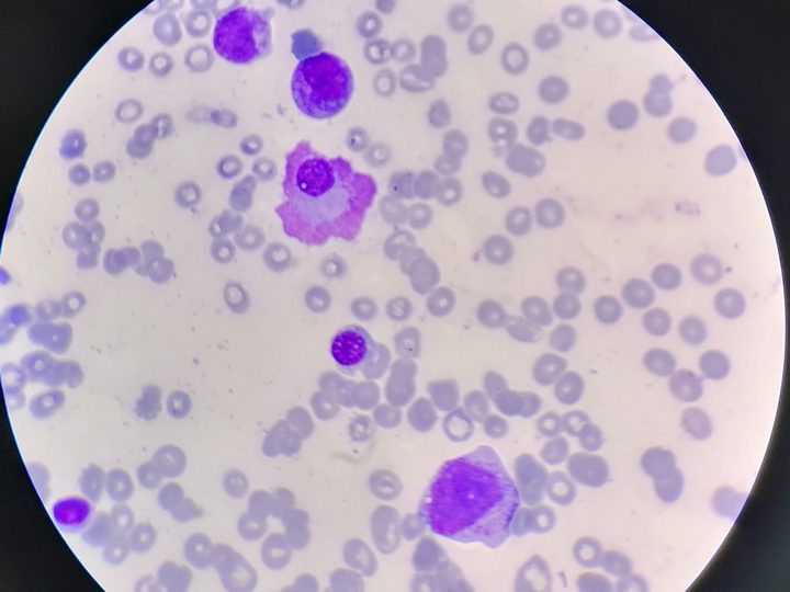 Blood smear: flame plasma cell with characteristic pink cytoplasmic rim