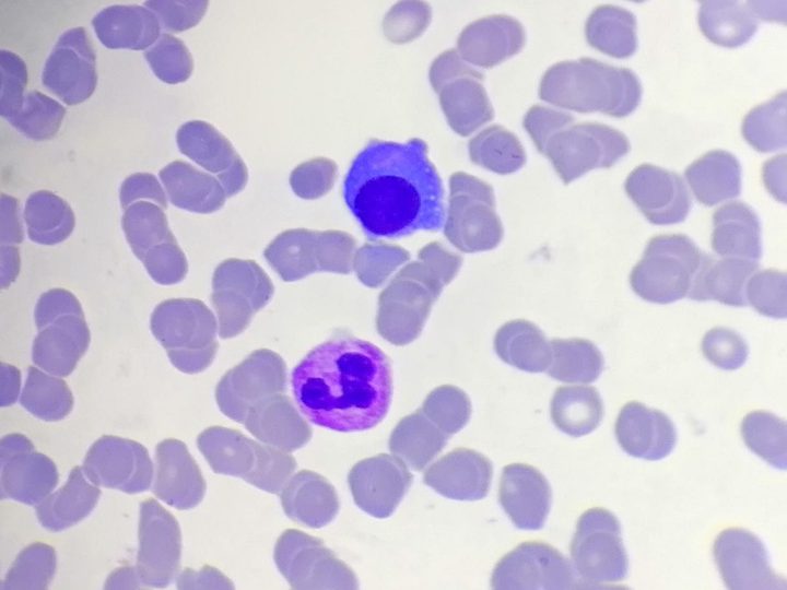 Blood smear: plasmacyte with a clear perinuclear zone and a segmented neutrophil