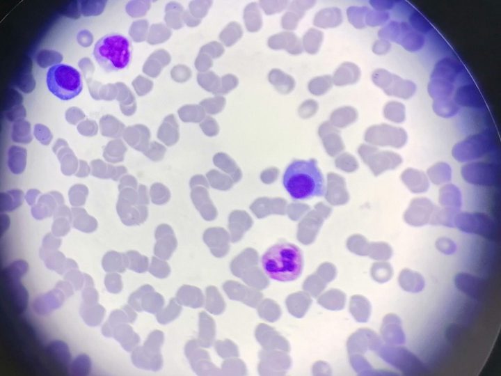 Blood smear: plasmacyte, segmented neutrophil, and lymphocyte in the microscope field of view
