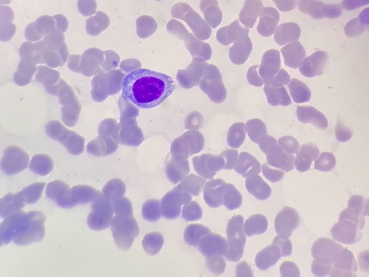 Blood smear: typical plasmacyte with dense chromatin and basophilic cytoplasm