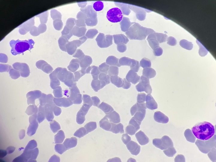 Blood smear: plasma cell with cytoplasmic projections and a segmented neutrophil