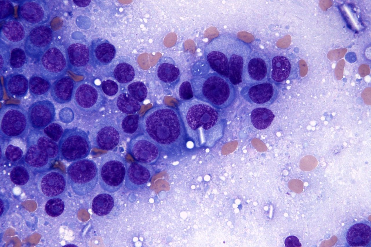 Plasmablastic Transformation of Myeloma in Lymph Node Imprint