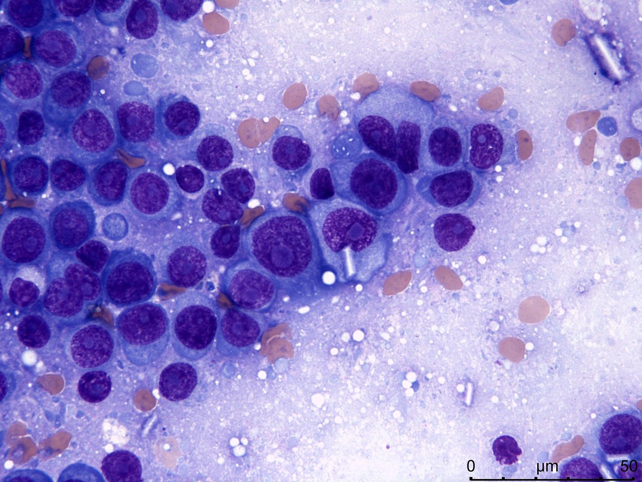Plasmablastic Transformation of Myeloma in Lymph Node Imprint
