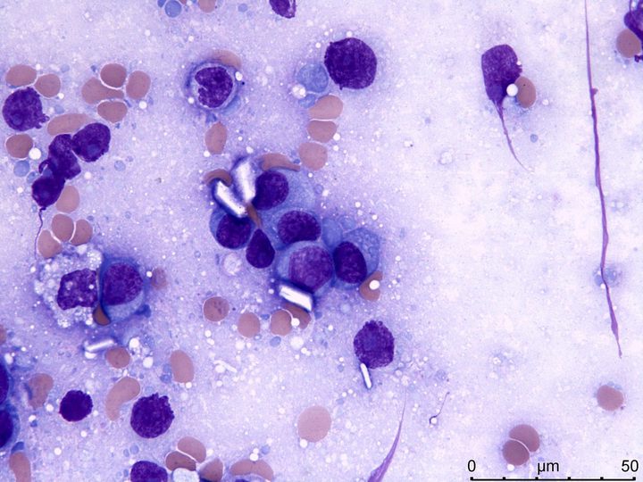 Lymph node imprint: plasma cells with large protein crystals
