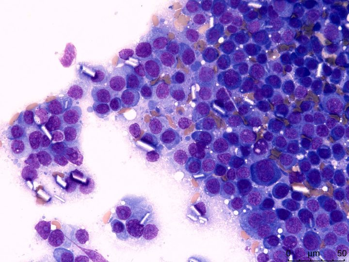 Cytological preparation of imprint: plasmablasts and free crystals