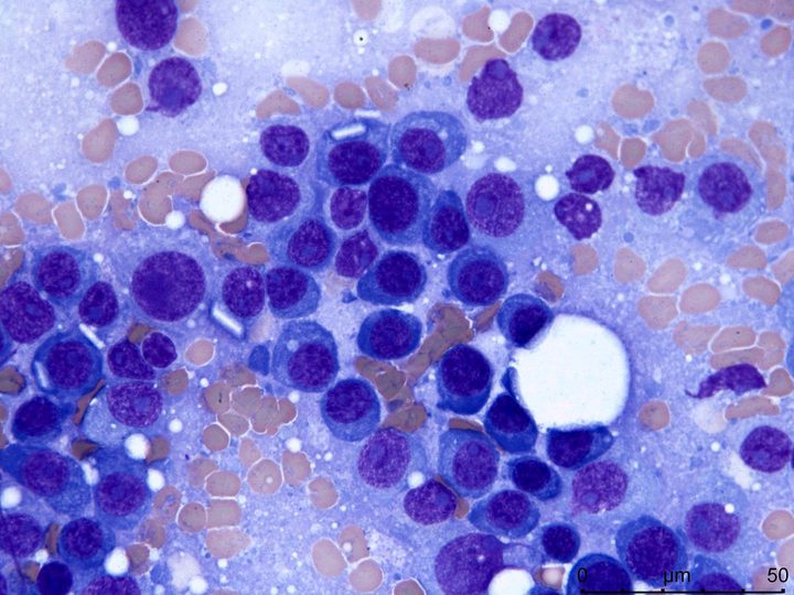 Lymph node imprint: accumulation of tumor cells and immunoglobulin crystals